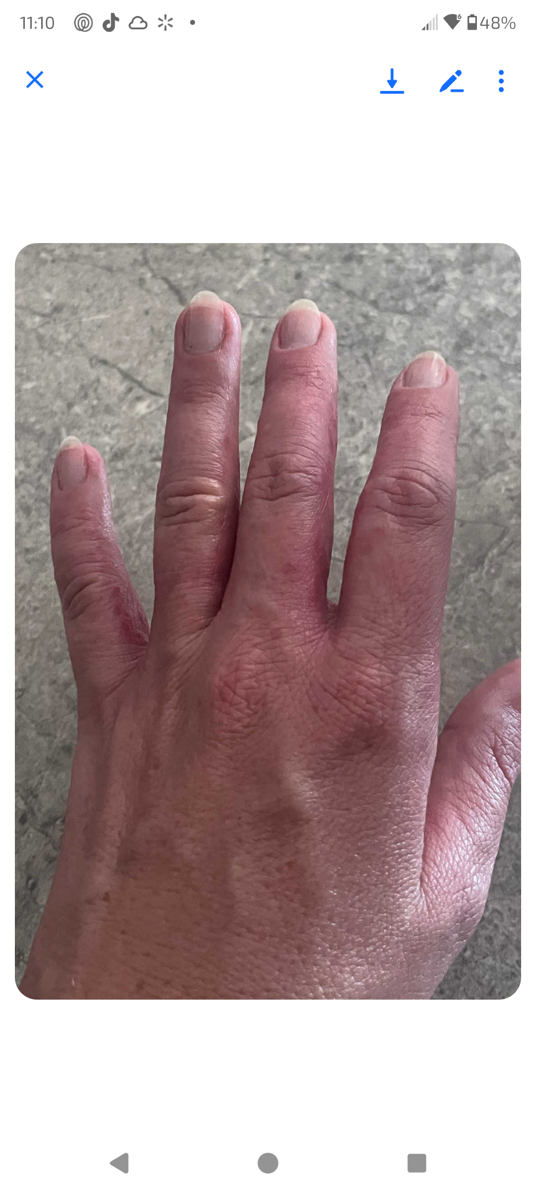 Eczema?   Grass-fed beef tallow with castor oil and jojoba oil usnea, burdock root, Eczema relief